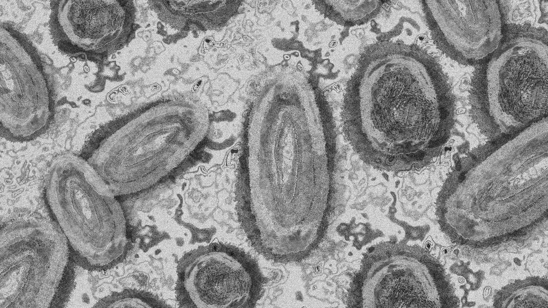 Variole du singe : 66 cas désormais confirmés en France