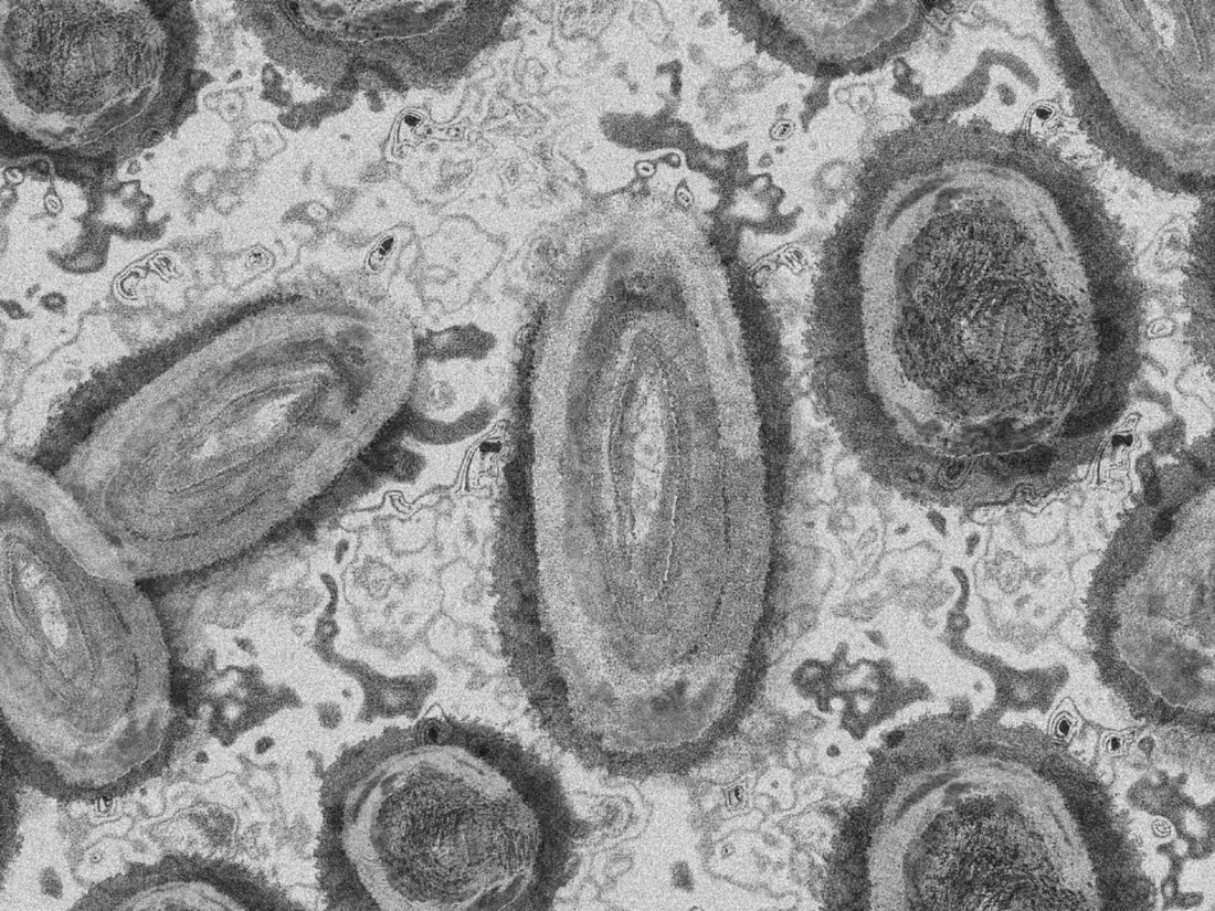 Variole du singe : un premier cas identifié au CHU de Bordeaux
