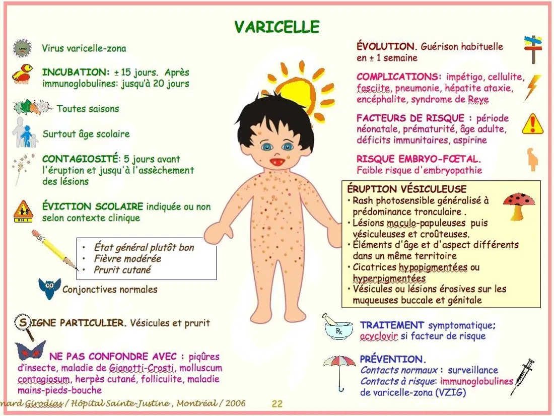 Attention à la varicelle