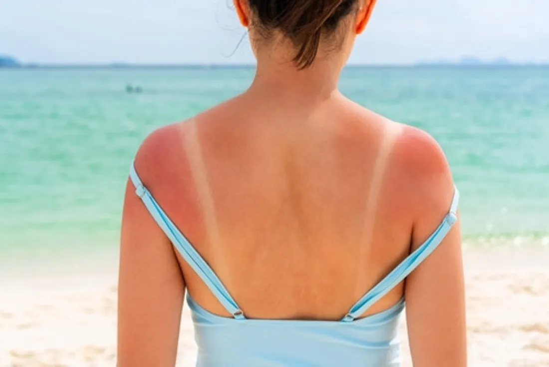 burn lines