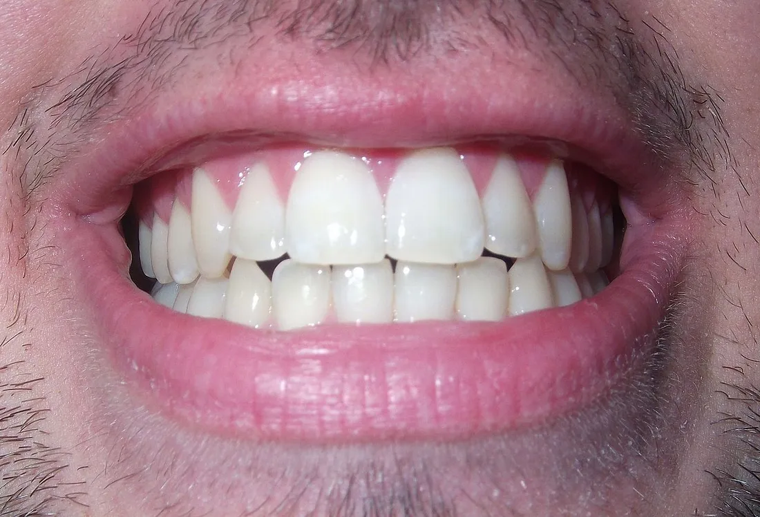 Dents