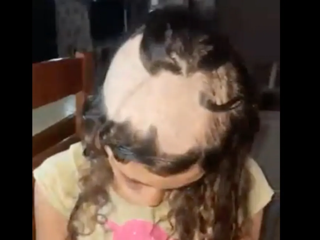 Trichotillomanie infantile : quand bébé s'arrache les cheveux