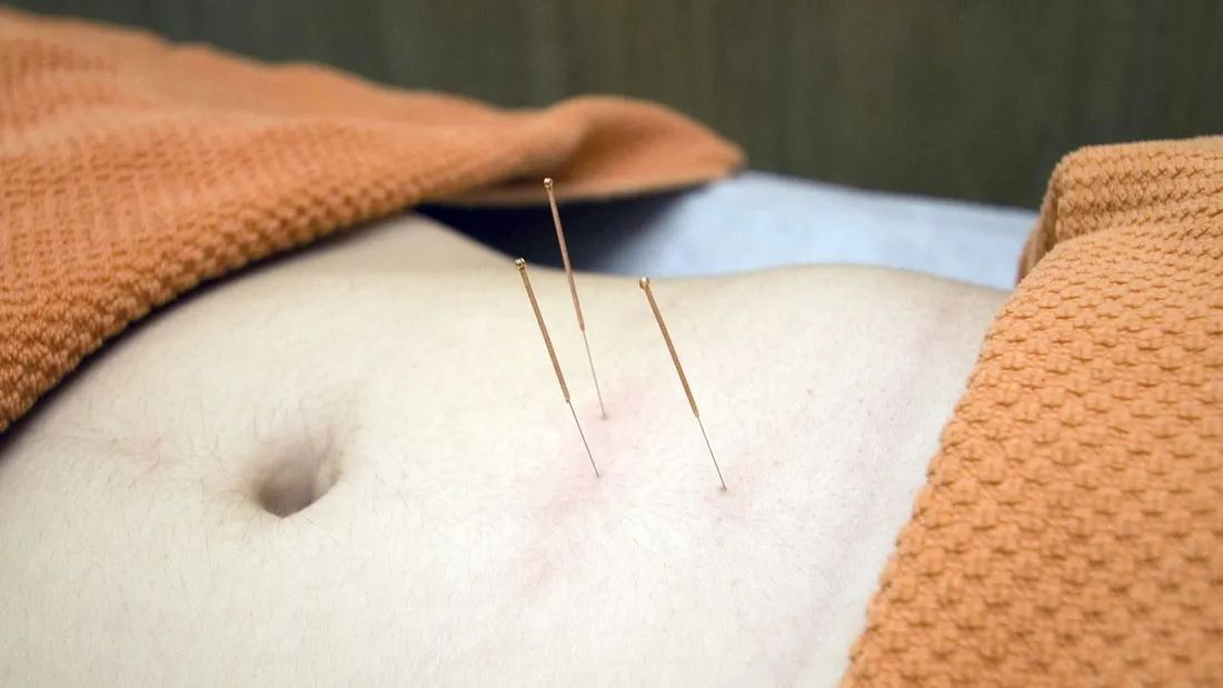 L'acupuncture fait partie des pratiques de soins non-conventionnelles.