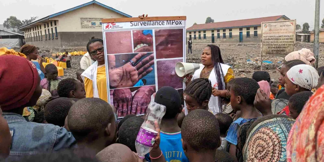 La RDC est le foyer et l’épicentre de l’épidémie de mpox