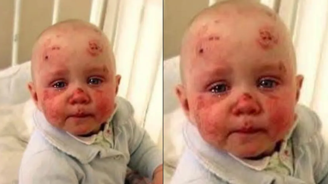 bébé tuméfié