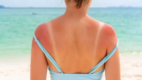 C’est une tendance dangereuse... Les « Sun tattoo » dans le viseur...