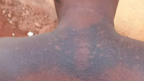 Mali : Des femmes devenues aveugles après utilisation de produits...