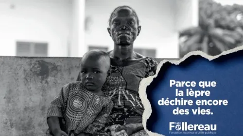 Santé : La lèpre sévit toujours 
