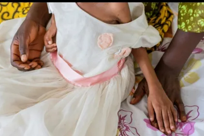 RD Congo: au chevet des enfants malnutris du Kasaï