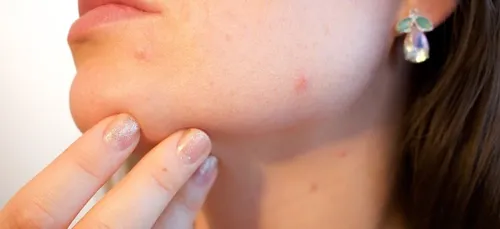 Des délais toujours plus longs pour trouver un dermatologue