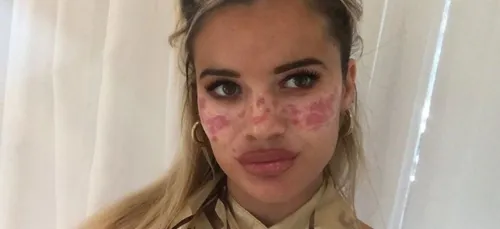 Une influenceuse défigurée après avoir voulu tester une routine...