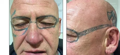 Bourré il se tatoue une paire de lunettes sur le visage ! (photos)