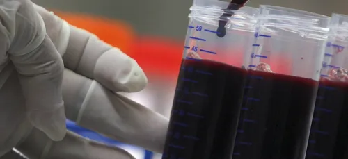 5 patients guérissent du SIDA grâce à un étrange cocktail de...