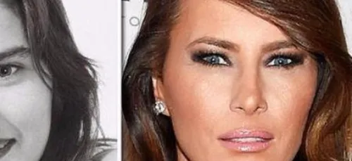 Melania Trump aurait dépensé 16.000 dollars en chirurgie...