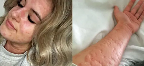 Improbable : Cette jeune femme de 21 ans est allergique à l'hiver !